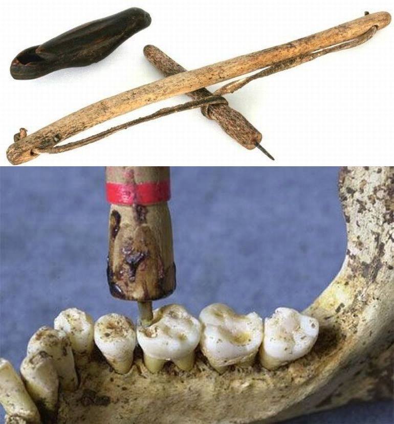 harappan civilization tooth drilling tool